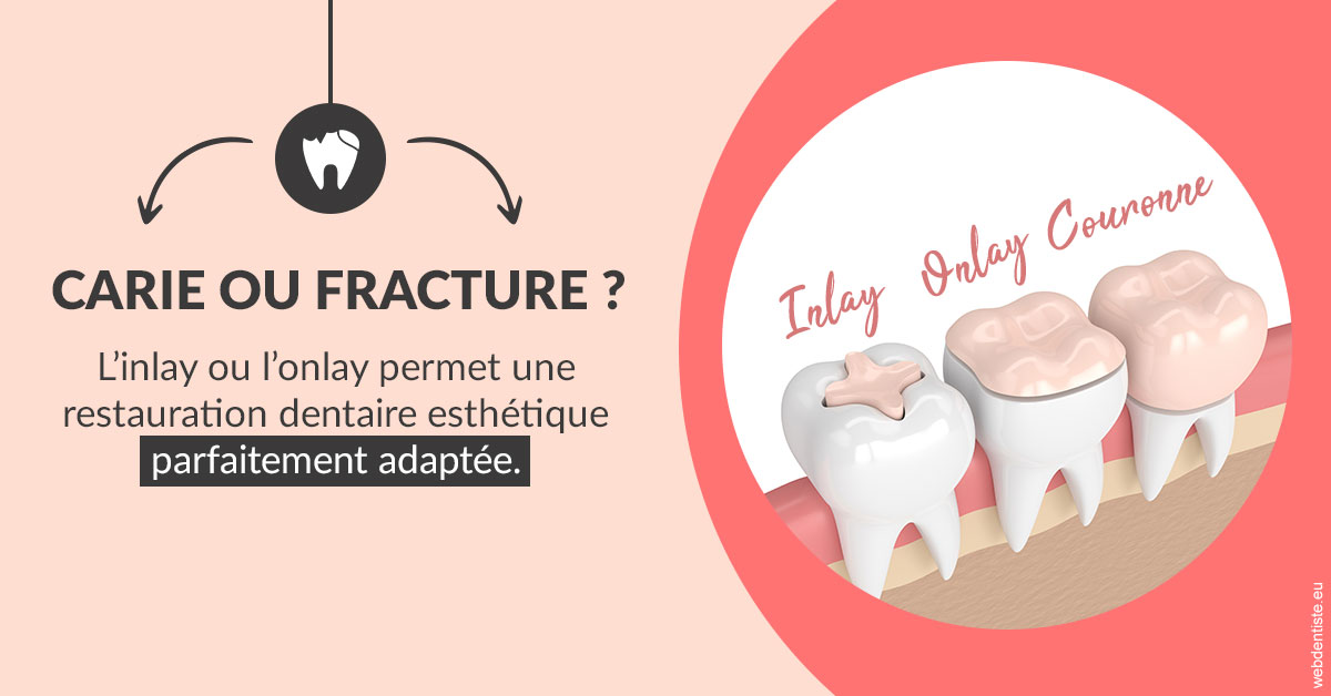 https://selarl-du-docteur-mangez.chirurgiens-dentistes.fr/T2 2023 - Carie ou fracture 2
