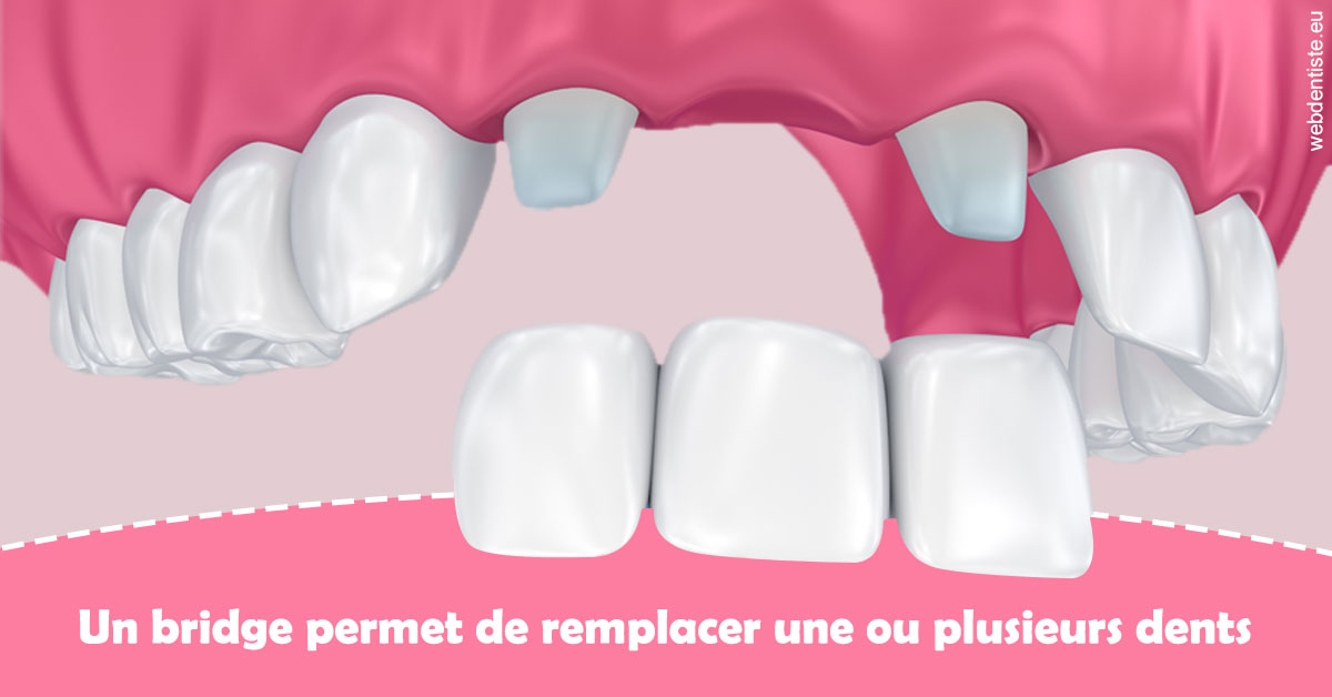 https://selarl-du-docteur-mangez.chirurgiens-dentistes.fr/Bridge remplacer dents 2