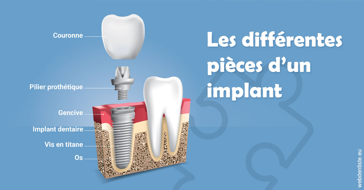 https://selarl-du-docteur-mangez.chirurgiens-dentistes.fr/Les différentes pièces d’un implant 1